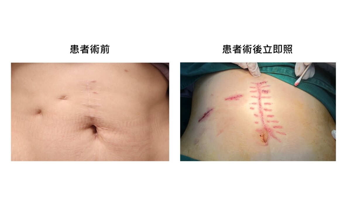 腹部20公分白疤困擾多年 「白疤之父」妙手助婦人重拾自信 6ce49c462e6f197e31553369be8501e7