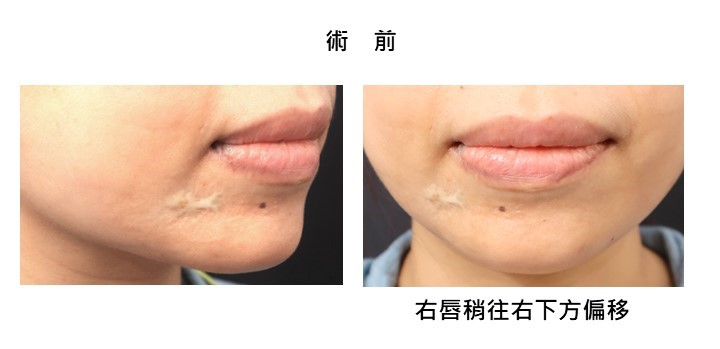 白疤之父曹賜斌運用再生醫療 帶患者重拾臉部光采 05593a986139db3c95c900f7fb882360